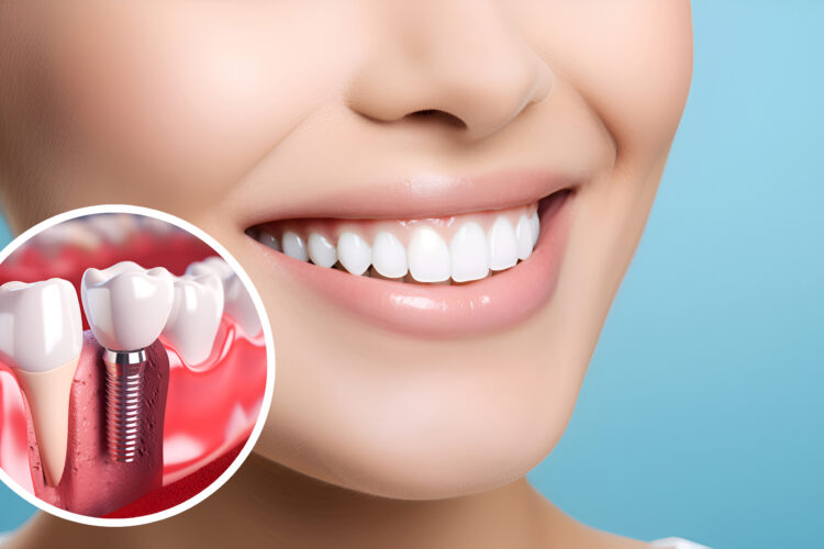 Dental Implats